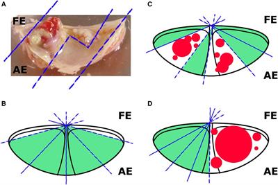 Ex vivo model of pathological calcification of human aortic valve